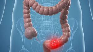 Cáncer de colon: el diagnóstico precoz posibilita un 90% de curación