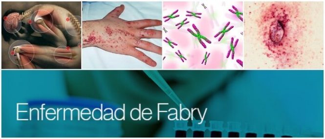 Enfermedad de Fabry: una afección rara que puede tratarse