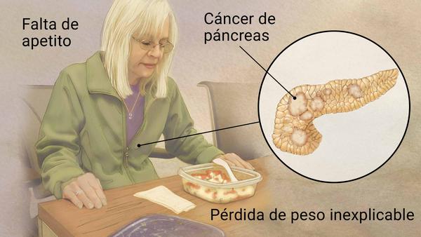 Cáncer de Páncreas: Tabaco y alcohol, grandes factores de riesgo